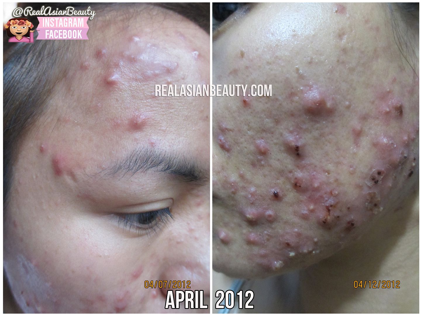Join. acne asian best cream treatment 3956 Acne asian best cream treatment 3956 there are